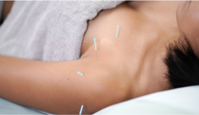 Acupuncture